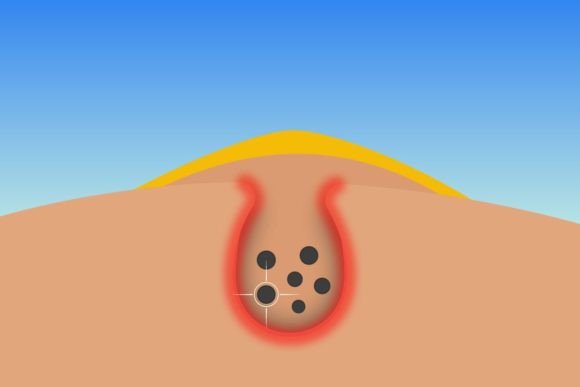 Download Killing Dark Spots Under Skin Vector - Premium Resources